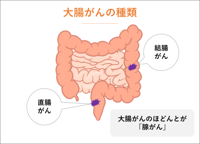 大腸がんの種類