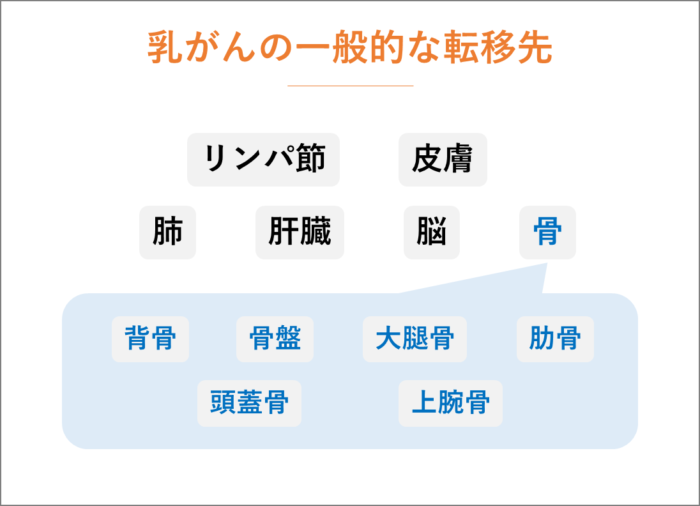 乳がんの最も一般的な転移先とその特徴