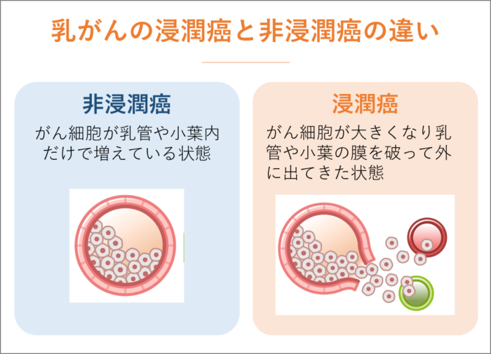 乳がんの浸潤癌と非浸潤癌の違いについて